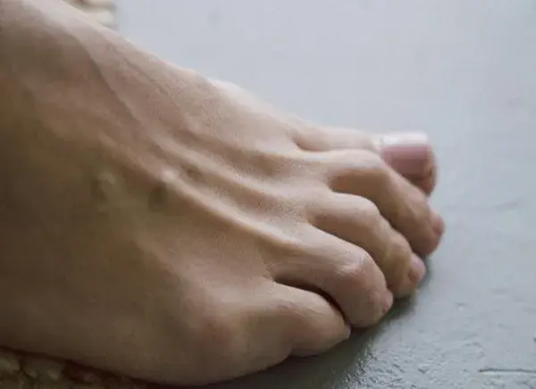 Wenn jeder Schritt schmerzt: das Morton-Metatarsalgie-Syndrom