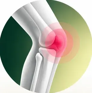 Schmerzbild-Grafik: Arthrose im Knie