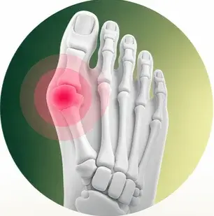 Schmerzbild-Grafik: Hallux Valgus am Fuß