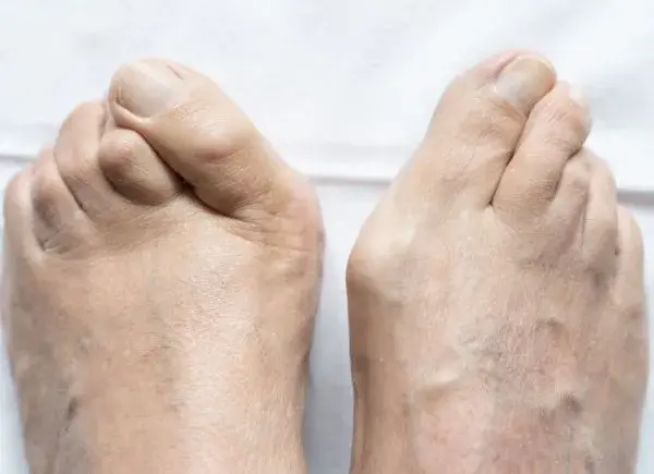 Von Schuhwerk bis Therapie: Alles, was Sie über Hammerzehen wissen müssen